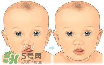 兔唇能檢查出來嗎？兔唇能完全修復(fù)嗎？