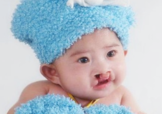 兔唇可以治嗎？兔唇修補術(shù)