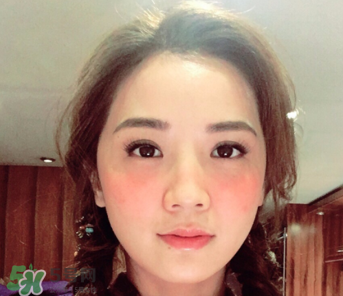 夏天可以點(diǎn)痣嗎？夏天點(diǎn)痣后要注意什么？