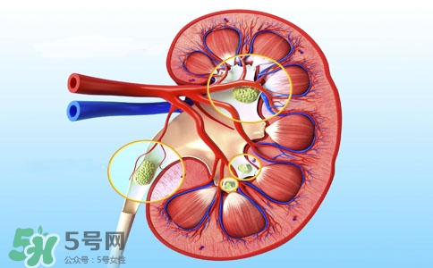 腎結(jié)石有什么癥狀？腎結(jié)石原因