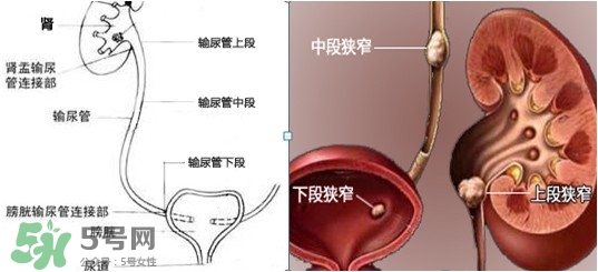 腎結(jié)石怎么治最好？腎結(jié)石的醫(yī)治方法