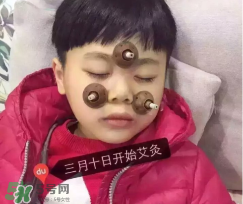 艾灸貼可以治咳嗽嗎？艾灸貼可以治退燒嗎？