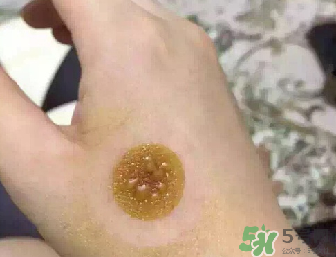 艾灸貼后有水泡怎么辦？貼艾灸貼應(yīng)注意些什么？