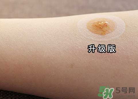 艾灸貼后有水泡怎么辦？貼艾灸貼應(yīng)注意些什么？
