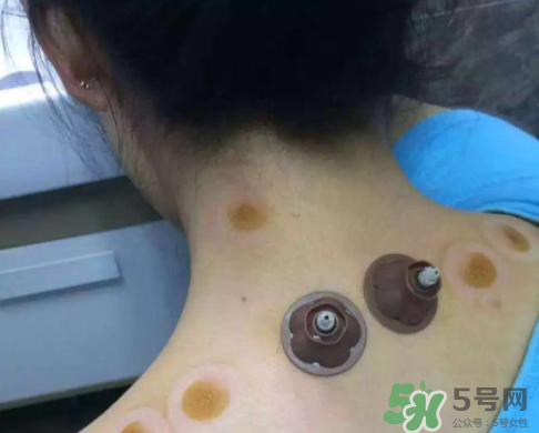艾灸貼后有水泡怎么辦？貼艾灸貼應(yīng)注意些什么？