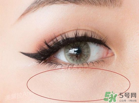 玻尿酸填充淚溝多久恢復自然？玻尿酸填充淚溝的危害