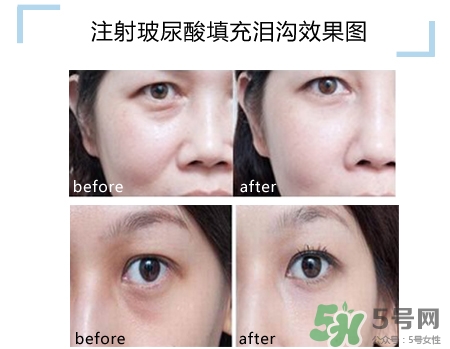 玻尿酸填充淚溝多久恢復自然？玻尿酸填充淚溝的危害