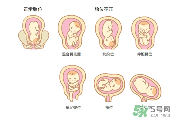 胎位不正如何矯正？胎位不正一定要剖腹產(chǎn)嗎？