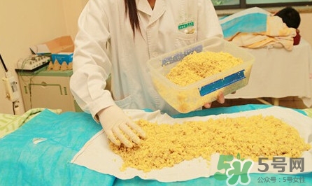 隔姜灸效果怎么樣？隔姜灸好還是直接灸好