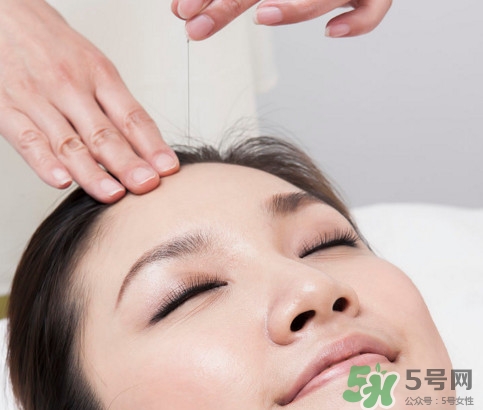 針灸可以自己扎嗎？針灸可以減肥嗎