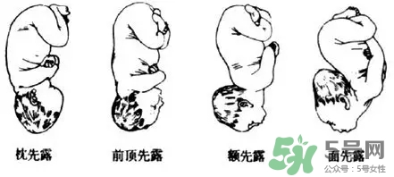 胎位不正能順產(chǎn)嗎？胎位不正怎么辦？