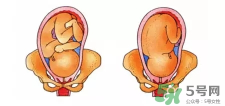 胎位不正能順產(chǎn)嗎？胎位不正怎么辦？