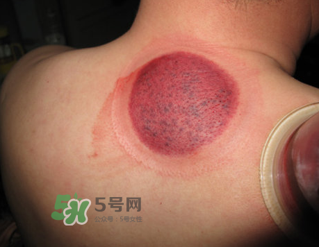 三伏天拔罐后多久可以洗澡？三伏天拔罐后注意事項