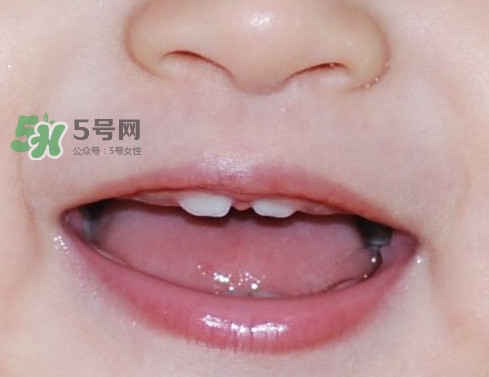 牙齒縫隙大怎么辦？牙縫大帶牙套有用嗎
