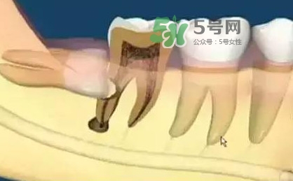 智齒是每個(gè)人都會(huì)長(zhǎng)嗎？拔智齒能瘦臉嗎？