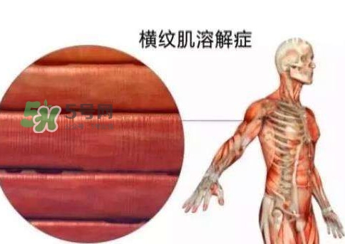 橫紋肌溶解癥會死亡嗎？橫紋肌溶解癥能活多久