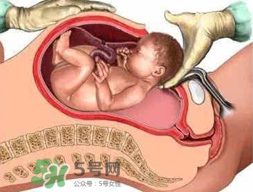 剖腹產(chǎn)比順產(chǎn)安全嗎？剖腹產(chǎn)產(chǎn)后注意事項？