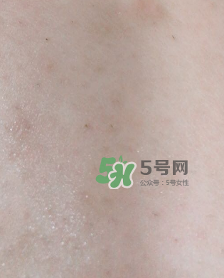 Dermatix舒痕疤痕膏有效嗎？Dermatix舒痕疤痕膏怎么用？