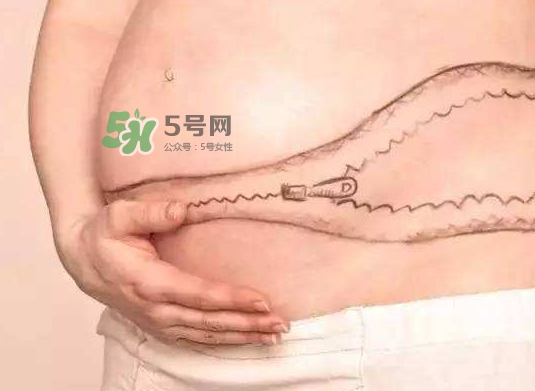 剖腹產(chǎn)疤痕怎么去除？剖腹產(chǎn)疤痕能去掉嗎？