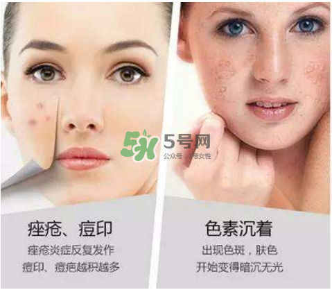 果酸換膚自己可以做嗎？果酸換膚后注意事項(xiàng)