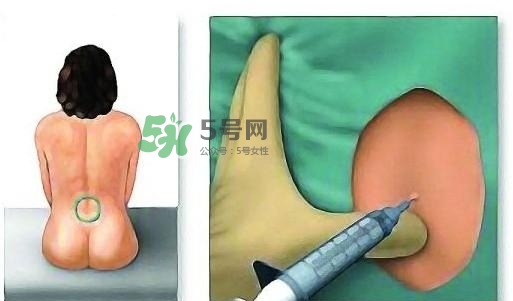 無痛分娩為什么不提倡？無痛分娩有后遺癥嗎？