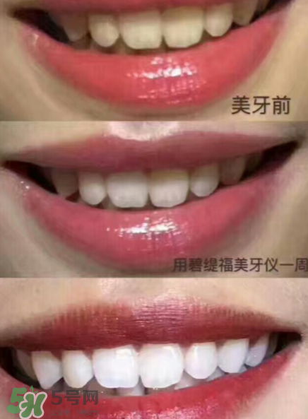 美牙儀能用水洗嗎？美牙儀能用多久？