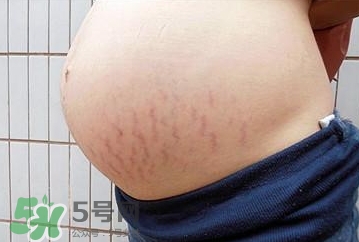 妊娠紋什么時候開始預(yù)防？妊娠紋什么時候消除？