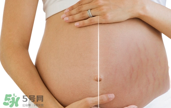 妊娠紋在左邊生男或女？怎么從妊娠紋看男女？