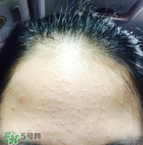 長痘長閉口怎么辦？長痘長閉口是什么原因？