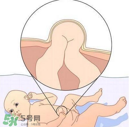 臍疝是什么？臍疝對(duì)寶寶有什么影響？