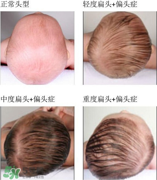 寶寶頭型是睡出來的嗎？寶寶頭型矯正最佳時(shí)間