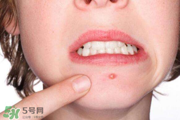暗瘡可以擠壓嗎？油性和骯臟肌膚會容易有暗瘡嗎？