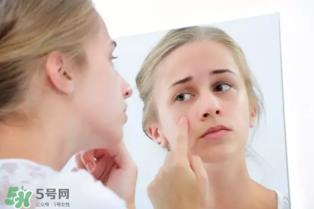 暗瘡可以擠壓嗎？油性和骯臟肌膚會容易有暗瘡嗎？