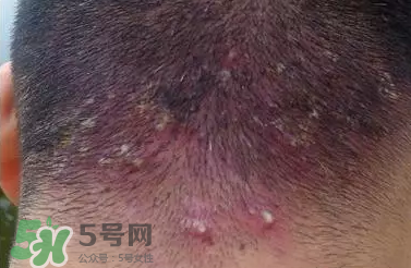 痤瘡和毛囊炎一樣嗎？痤瘡與毛囊炎區(qū)別