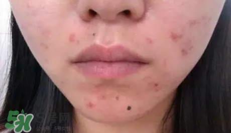 痤瘡和毛囊炎一樣嗎？痤瘡與毛囊炎區(qū)別