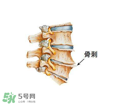 骨刺是怎么形成的？骨刺怎么治療？