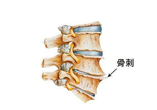 骨刺是怎么形成的？骨刺怎么治療？