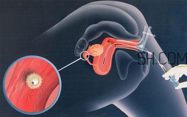人工授精取卵子怎么?。咳斯な诰腥嗽鯓尤【?？