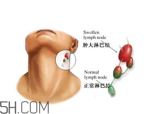 淋巴癌能活多久？淋巴癌癥狀有哪些