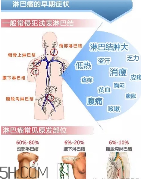 淋巴癌是怎么回事？淋巴癌如何診斷