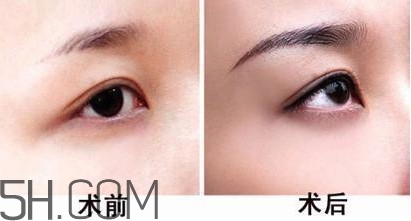 切眉手術(shù)后老得快嗎？切眉能保持多久？