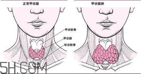 甲狀腺結(jié)節(jié)與甲狀腺腫瘤的區(qū)別有哪些？甲狀腺結(jié)節(jié)可以艾灸嗎