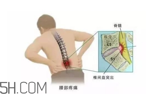 腰間盤突出是什么原因引起的？腰間盤突出是腎虛嗎