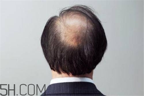 為什么男性比女性更容易脫發(fā)？什么原因?qū)е履行悦摪l(fā)？