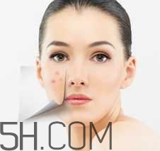 濕熱型痤瘡是什么？怎么調(diào)理濕熱型痤瘡？