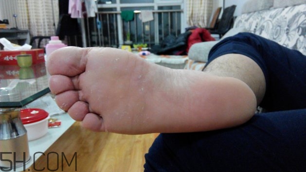 腳氣可以用酒精消毒嗎？腳氣可以用碘伏消毒嗎？