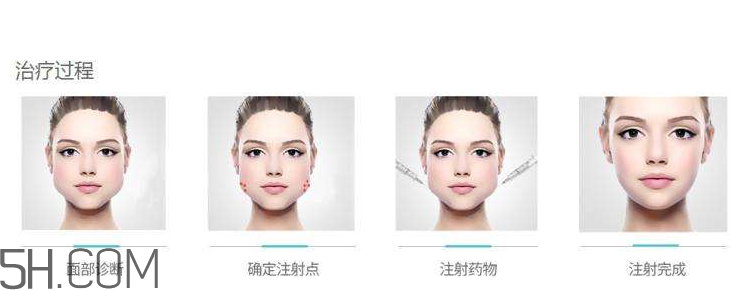 打瘦臉針可以抽煙嗎？打瘦臉針會反彈嗎？