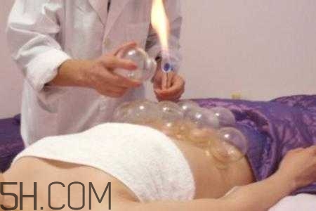 腹部拔罐可以減肥嗎？腹部拔罐拔哪個位置？