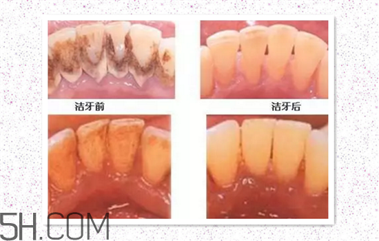 超聲波洗牙可以美白牙齒嗎？超聲波洗牙多少錢一次？