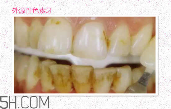 超聲波洗牙可以美白牙齒嗎？超聲波洗牙多少錢一次？